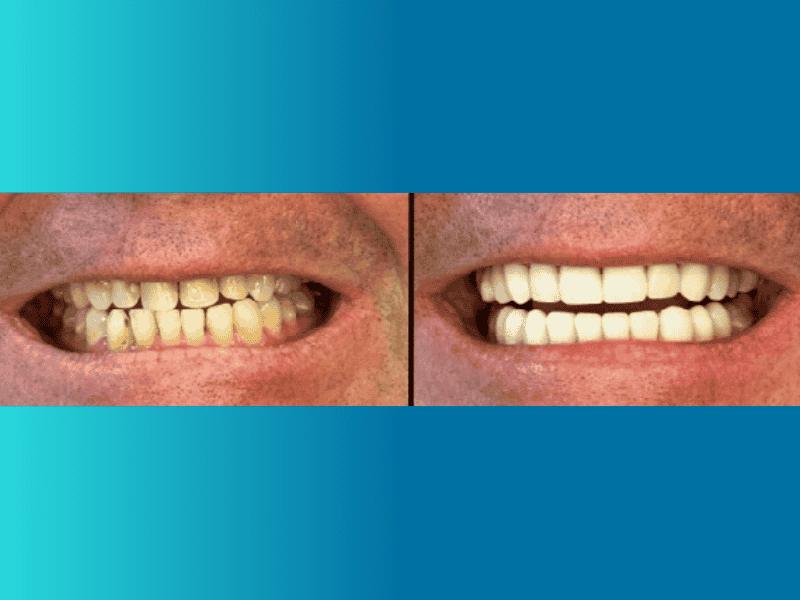 Dental Implants Colombia